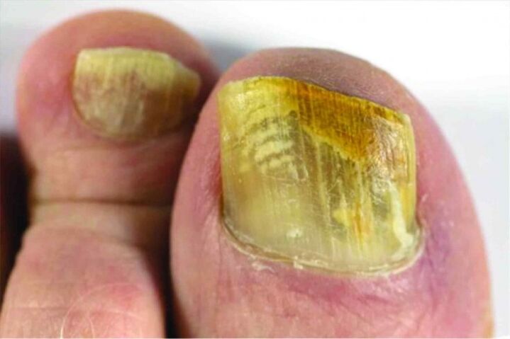 Nagelgefühl am Bein